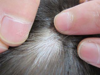 白癜风图片 白癜风症状图片